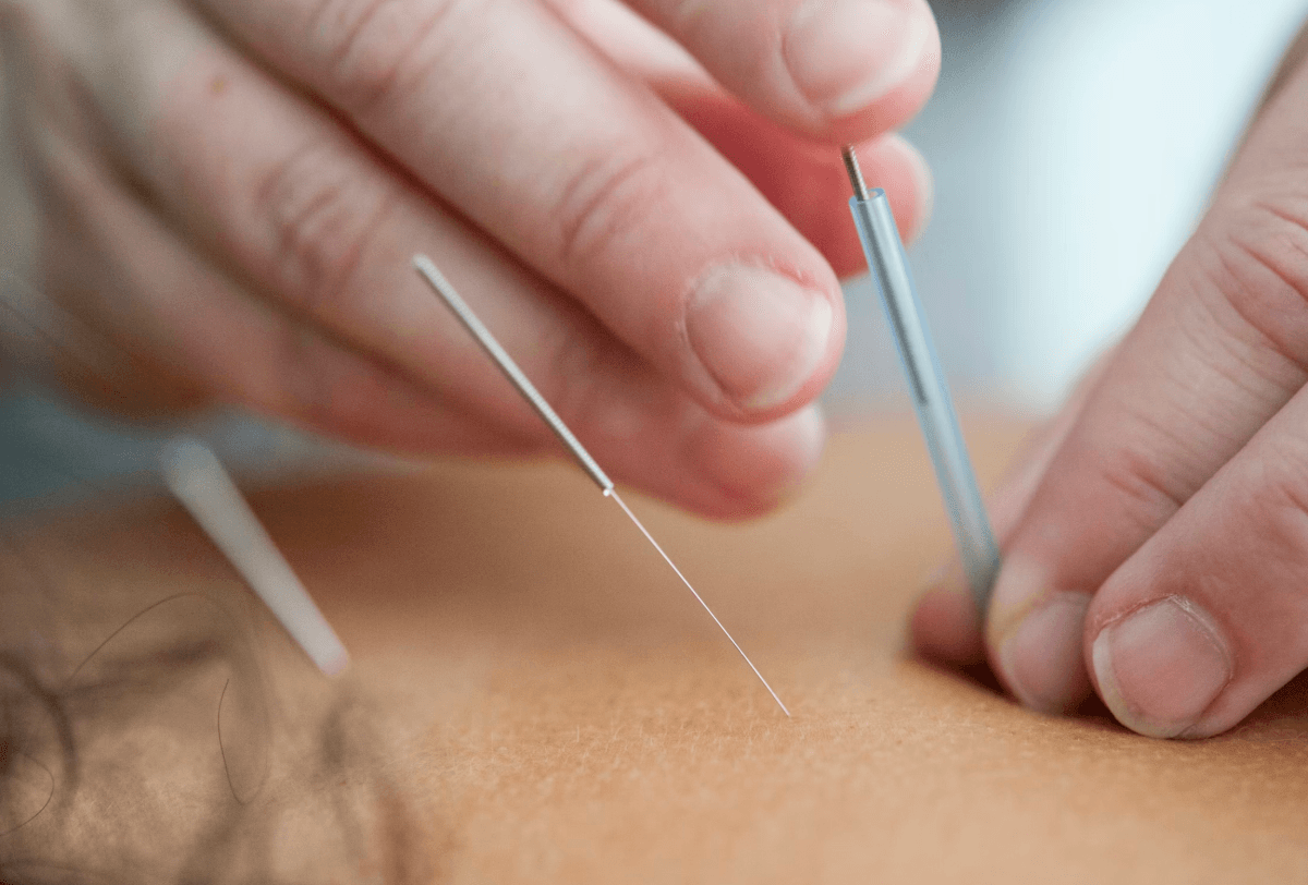 Health Coach Tip - The Benefits of Acupuncture