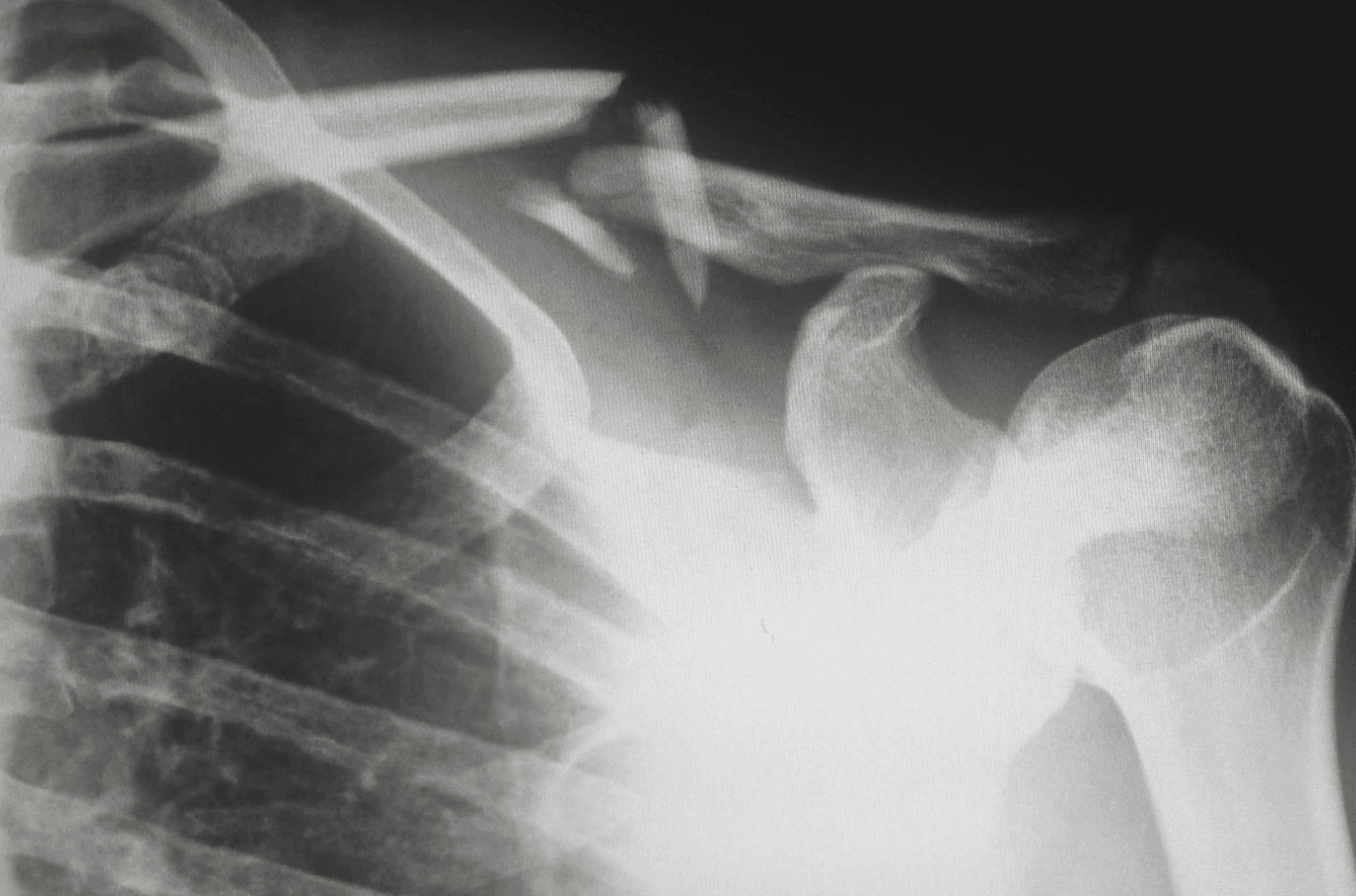 Osteoporosis - Take Action To Boost Your Bone Health